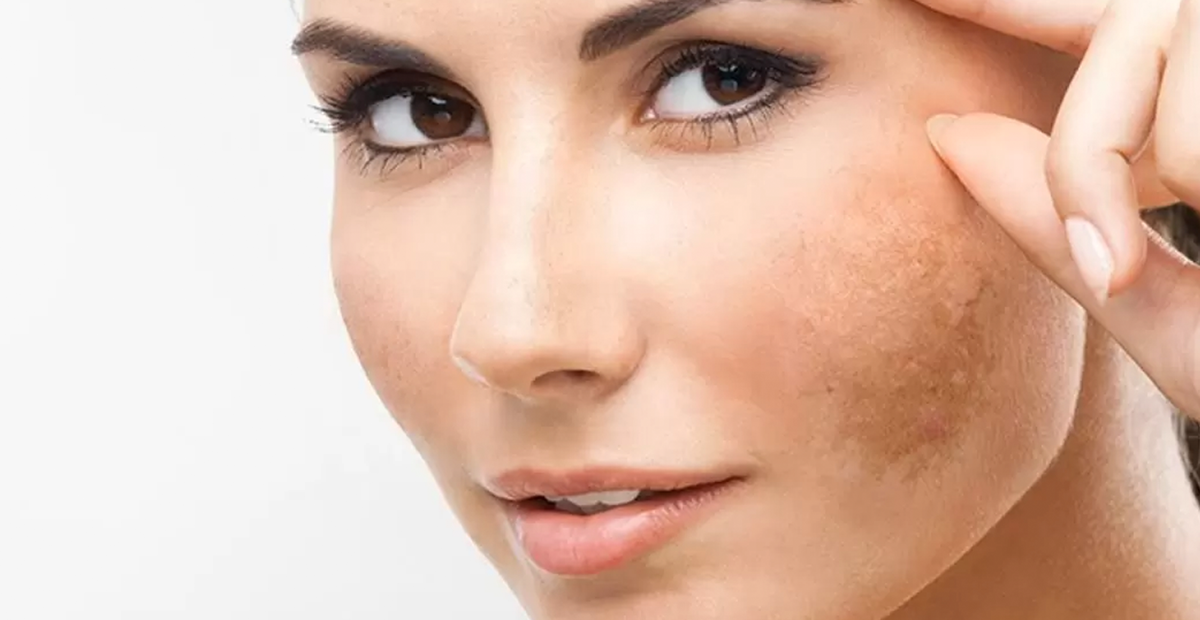 Kosmetik yang Menyebabkan Flek Hitam